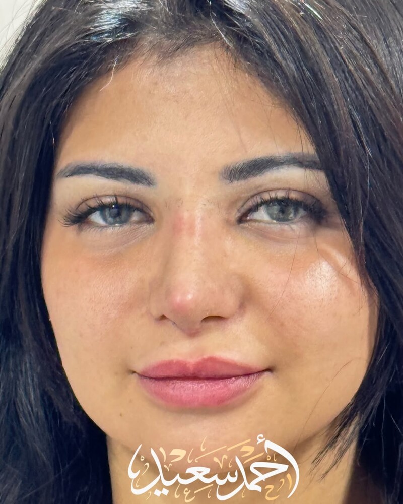 Before and After Result